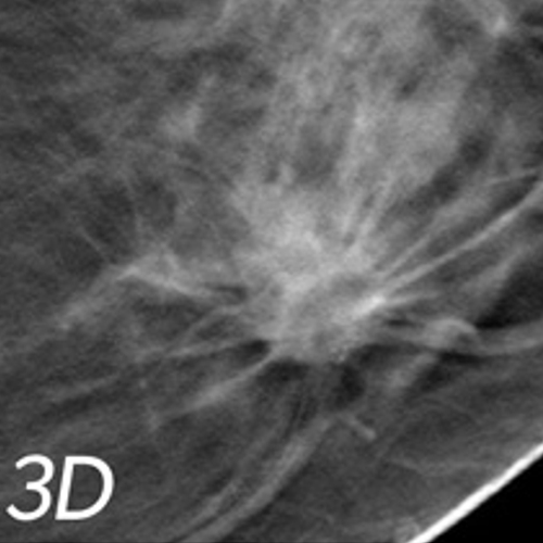 3D digital mammogram x-ray